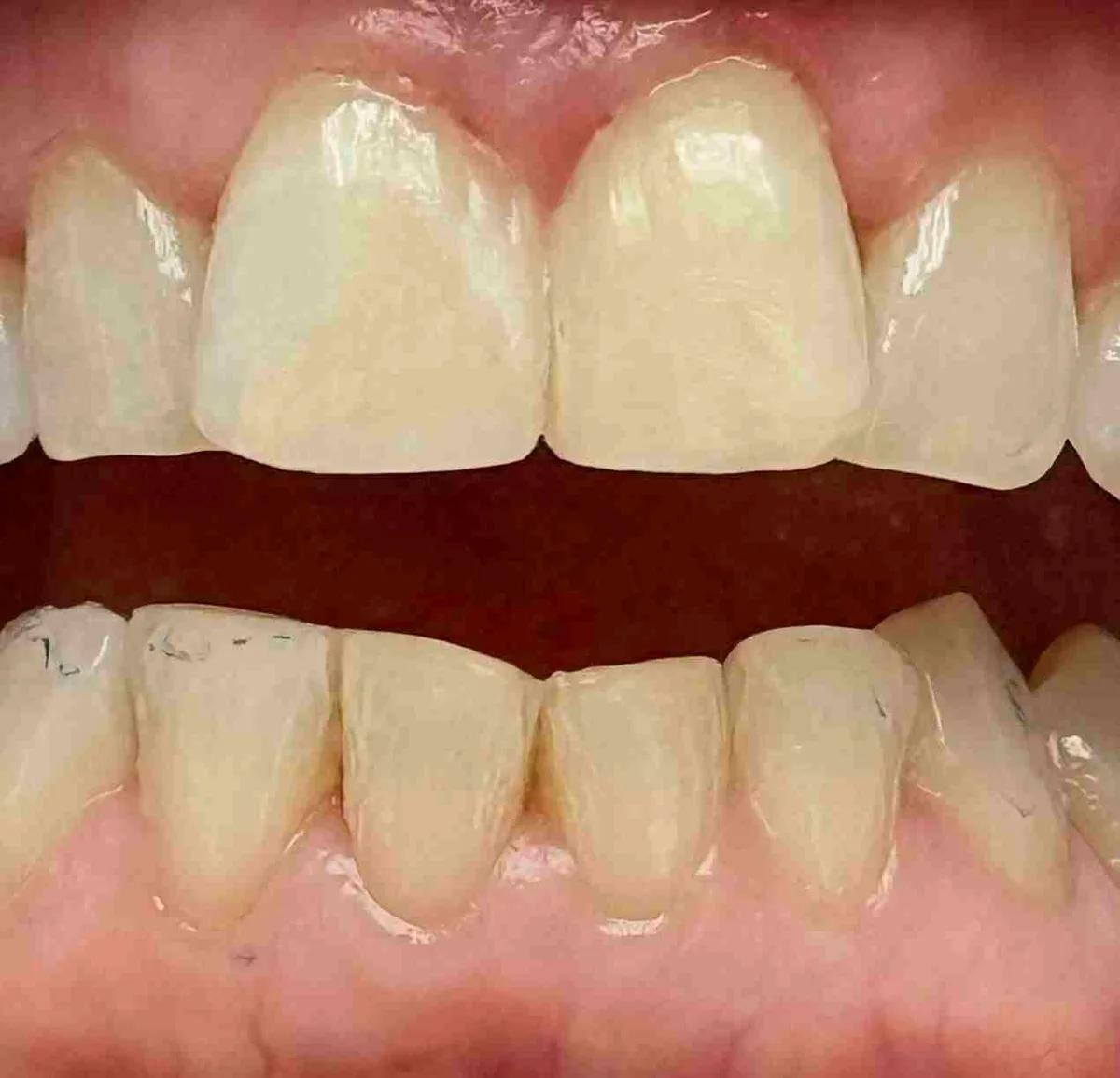 After: Chairside Composite Filling - Case Two