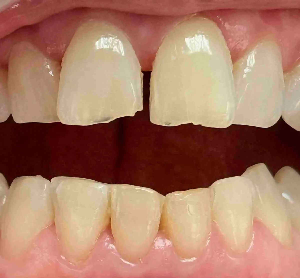 Before: Chairside Composite Filling - Case Two