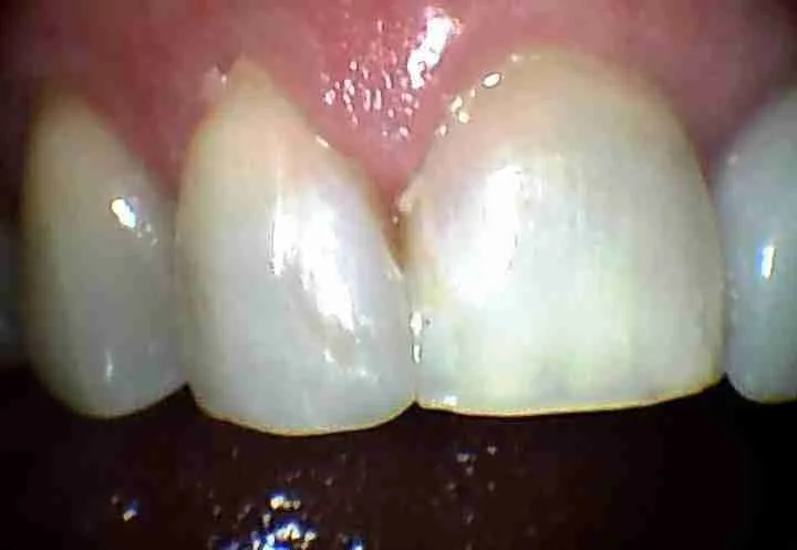 After: Chairside Composite Filling - Case Four