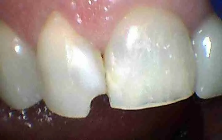 Before: Chairside Composite Filling - Case Four