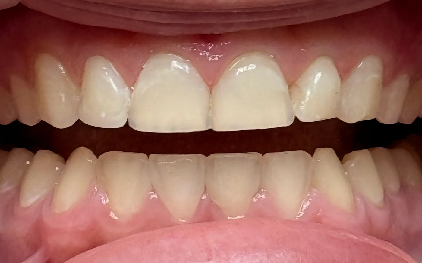 After: Upper & Lower Front Teeth - Same Patient
