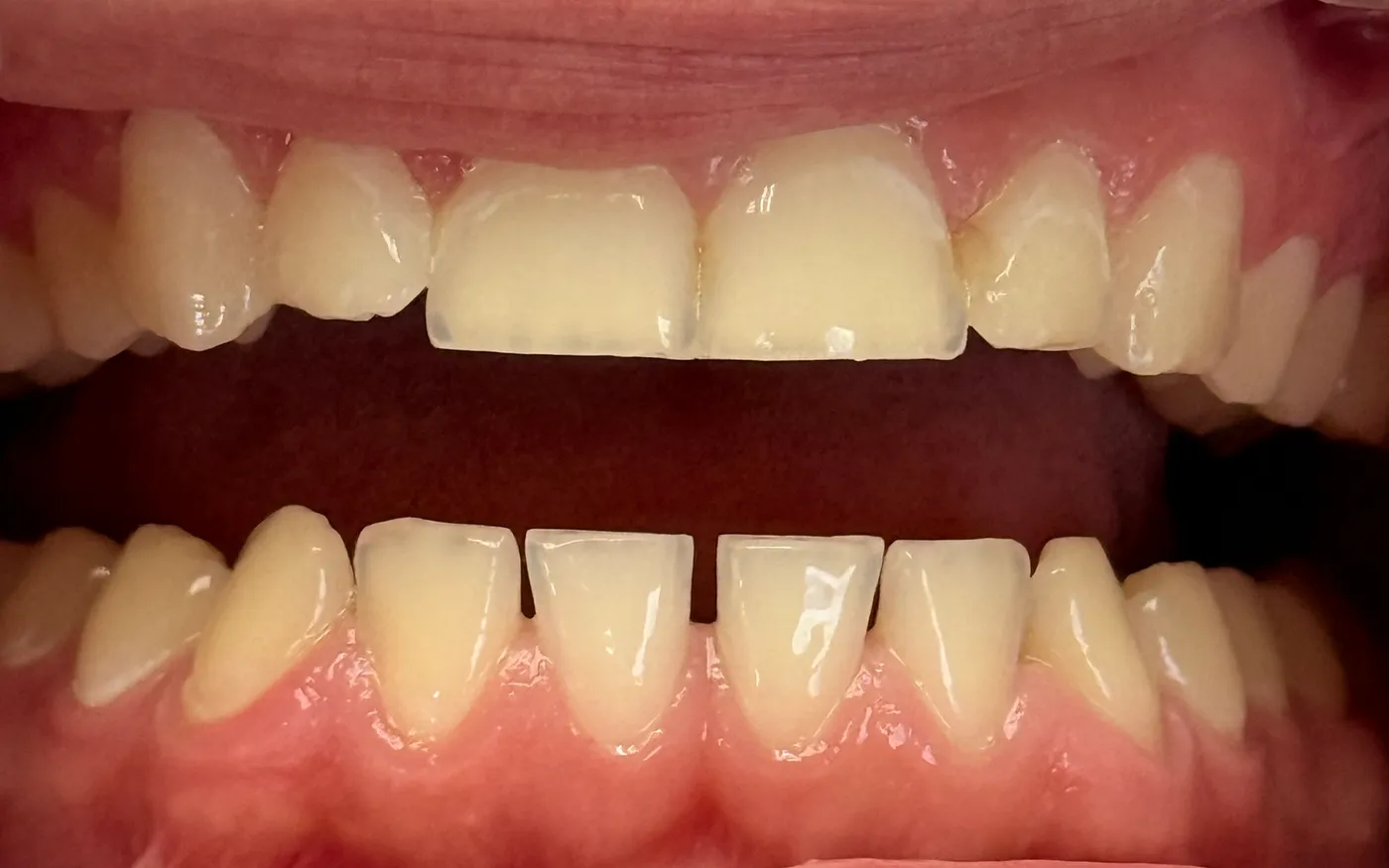 Before: Upper & Lower Front Teeth - Same Patient