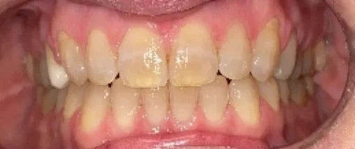 After: Upper Front Tooth & Lower Crowding