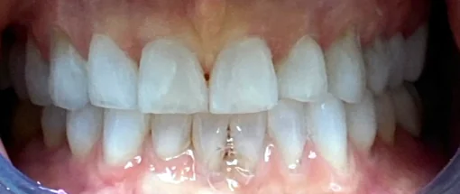 After: Edge-to-Edge Bite — Lower Crowding