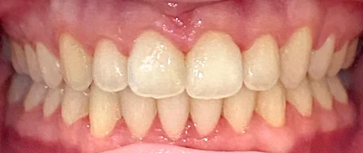 After: Spacing & Alignment Correction