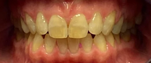 Before: Upper Front Tooth & Lower Crowding