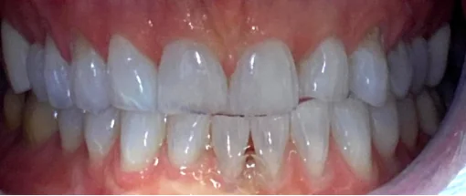 Before: Edge-to-Edge Bite — Lower Crowding