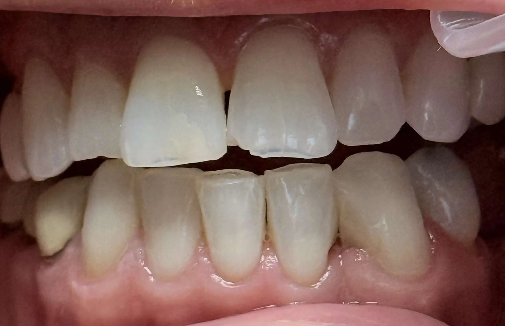 Chipped or Knocked-Out Tooth This Summer? Act Fast