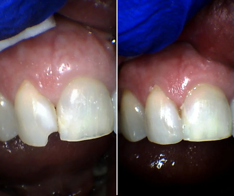 Chipped or Gapped Front Tooth? What Dental Bonding Can Fix