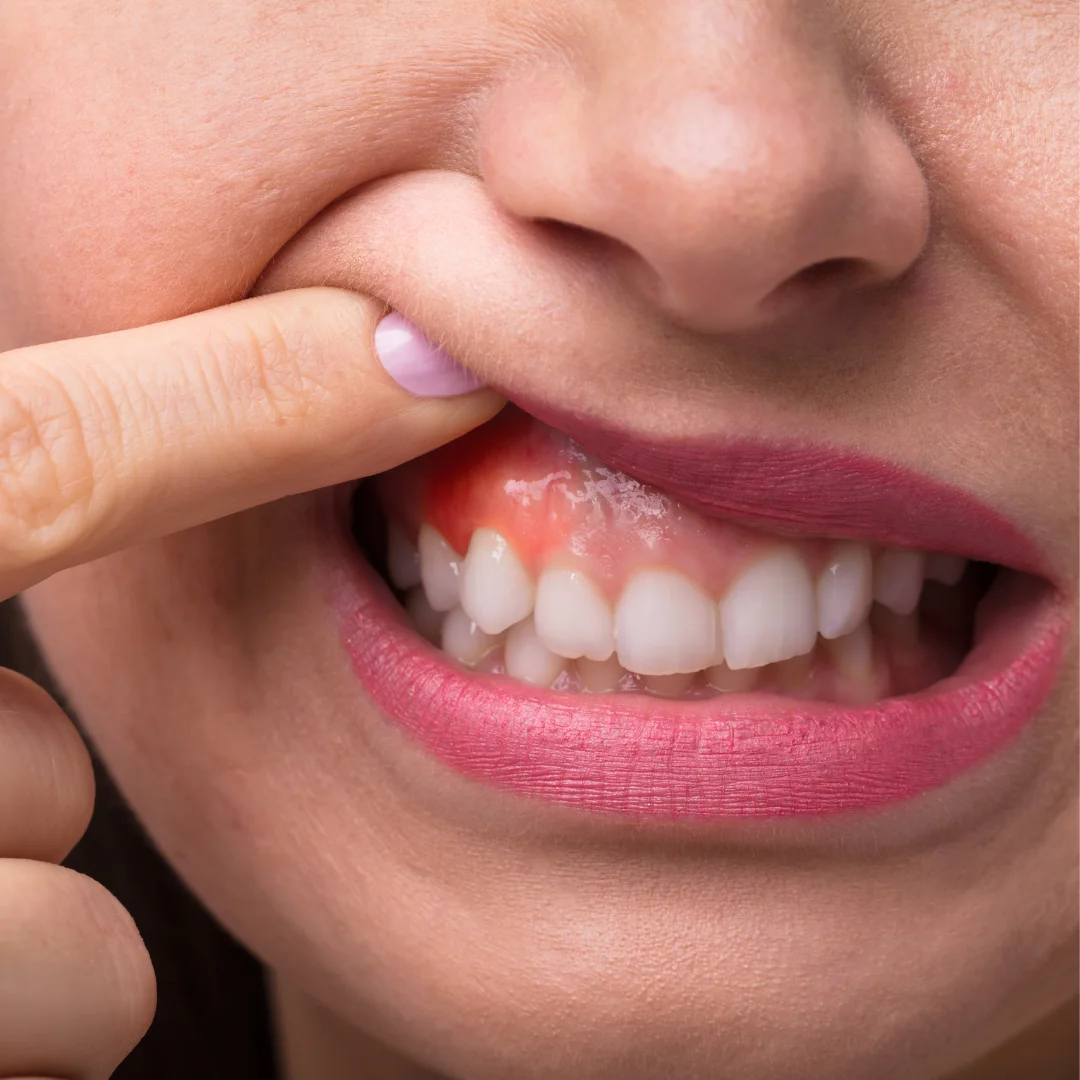 Gum Disease Treatment